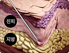 마이크로 니들
